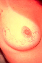 Ancylostoma, Larva migrans